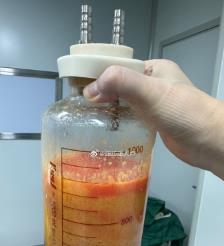 冠县水动力吸脂手术要做多久？